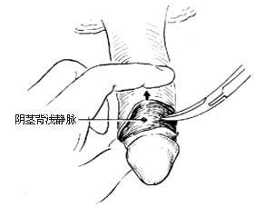 结扎阴茎背浅静脉止血